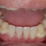 removable quadrotti denture