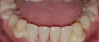 removable quadrotti denture