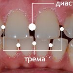 Gaps between teeth