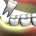 The suture protects the operated area from the accumulation of food debris - Dentistry Line Smiles