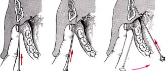 Syringe for intraligamentary anesthesia