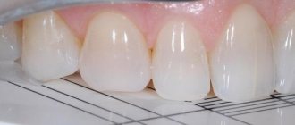 A systematic approach to modeling anterior teeth