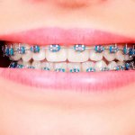 How long do you wear braces and what affects the timing?