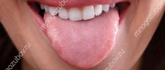 Следы от зубов на языке