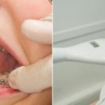 Removing braces and teeth whitening