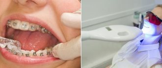 Removing braces and teeth whitening