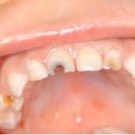 Modern methods of restoring damaged primary front teeth in children