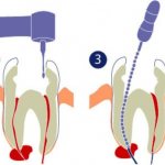 methods of treating dental cysts