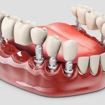 Сроки имплантации нескольких зубов