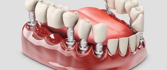 Сроки имплантации нескольких зубов