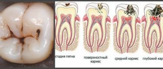 Стадии кариеса.