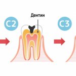 Stages of tooth damage.jpg