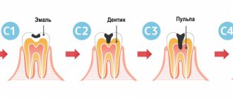 Stages of tooth damage.jpg