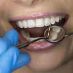 cost of veneers for front teeth, installation of veneers on teeth price