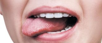 Stomatitis on the tongue - Dentistry &quot;Line of Smile&quot;