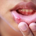 Stomatitis in a child