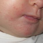 Rash around a child&#39;s mouth. Causes 2-3, 5-6 years, how to treat, what Komarovsky advises 