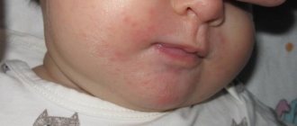 Сыпь вокруг рта у ребенка. Причины 2-3, 5-6 лет, чем лечить, что советует Комаровский