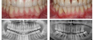 This is what periodontal disease looks like compared to healthy gums