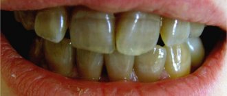 tetracycline teeth