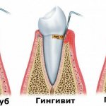 herbs for gum inflammation