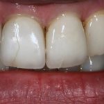 crack on front tooth