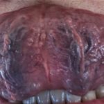 Thrombophlebitis of veins on the tongue