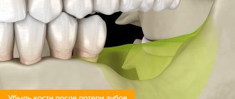 Bone loss after tooth loss in pictures