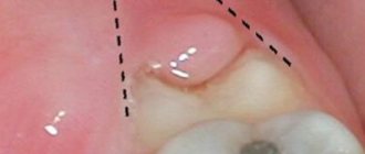 Tooth hood removal - Smile Line Dentistry