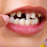 Removing plaque from children&#39;s teeth