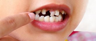 Removing plaque from children&#39;s teeth