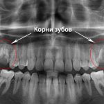 tooth root removal