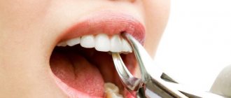 Удалить зуб могут по многим причинам