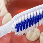 Caring for removable dentures