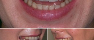 smile from different angles before dental prosthetics