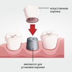 Implant installation in Moscow