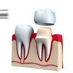 Installation of metal-ceramic prostheses