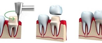 Installation of metal-ceramic prostheses