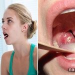 What are white lumps in the throat? Causes. Treatment methods 