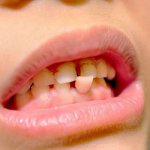 The importance of flux treatment - Line of Smile Dentistry