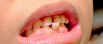 The importance of flux treatment - Line of Smile Dentistry