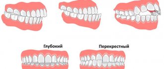 Types of occlusion defects and methods of their correction