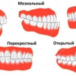 Types of malocclusion