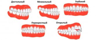 Types of malocclusion