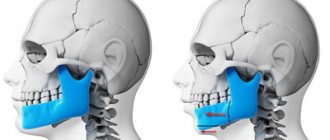 Types of operations to correct bite