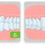 types of bite