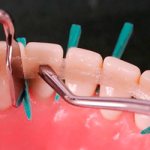 Types of dental splints - Alkoklinik