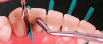 Types of dental splints - Alkoklinik