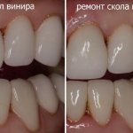 Veneers for distal bite