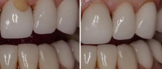 Veneers for distal bite